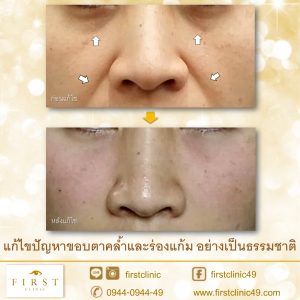 ตาคล้ำ-2a