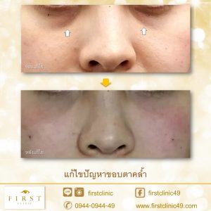 ตาคล้ำ-5
