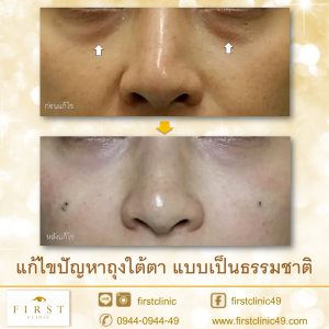 ถุงใต้ตา-1a