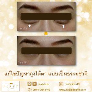 ถุงใต้ตา-2