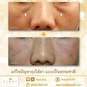 ถุงใต้ตา-3