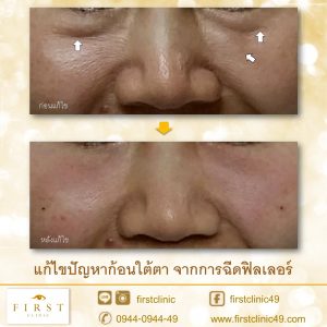 แก้-4